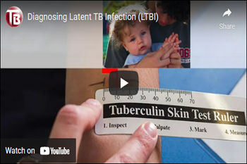 Diagnosing Latent TB Infection (LTBI) video