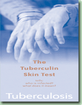 The Tuberculin Skin Test