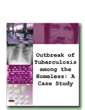 Outbreak of Tuberculosis among the Homeless: A Case Study